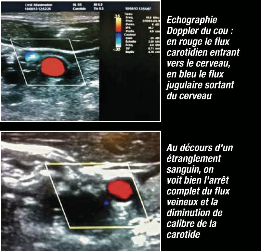 doppler lors d'un étranglement sanguin