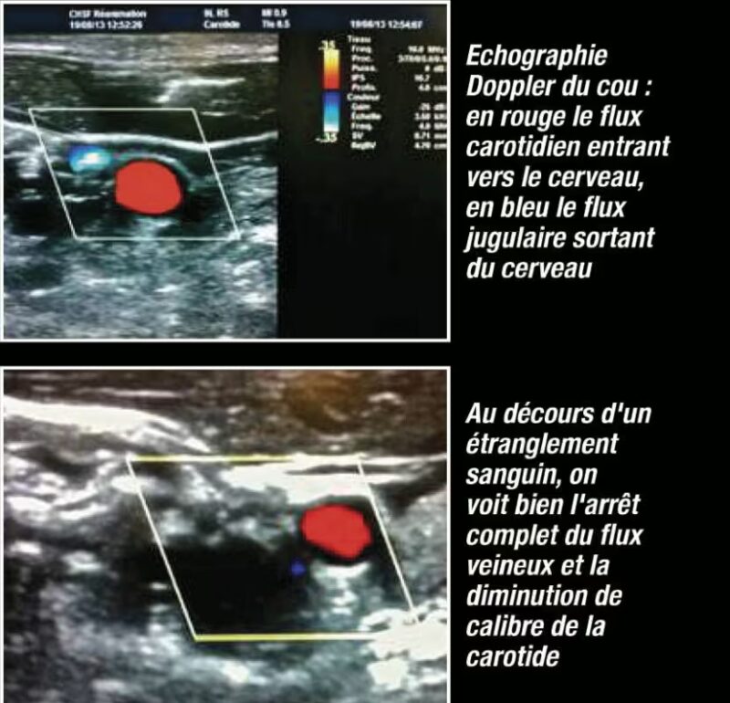 Échographie Doppler du cou montrant le flux sanguin dans la carotide et la veine jugulaire, ainsi que l’arrêt du flux veineux lors d’un étranglement sanguin.